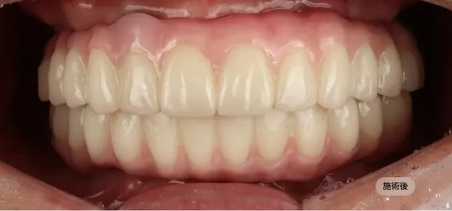 디지털 풀아치 임플란트 시술 후 하악 전악 복원 모습, 안정적인 교합을 완성한 블랑쉬치과 사례