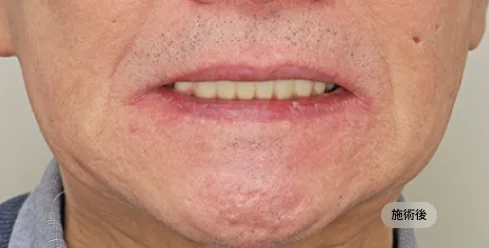 70대 남성 풀아치 임플란트 하악 시술 후 결과