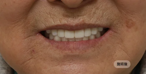 70대 여성 풀아치 임플란트 전악 시술 후 결과