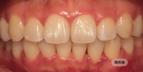 20代男性の前歯矯正治療後の写真