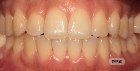 20代女性の歯列咬合矯正治療後の写真