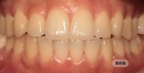 20代女性の歯列咬合矯正治療後の写真