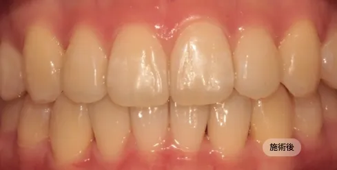 20代女性のインビザライン矯正治療後の写真