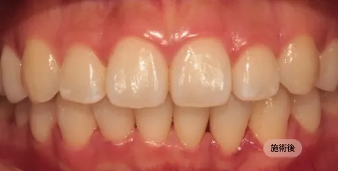 30代男性の前歯矯正治療後