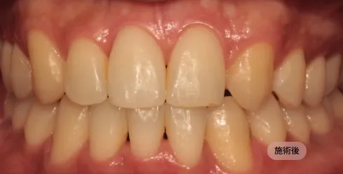 30代男性の先天性欠損治療後