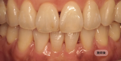 40代女性のインビザライン矯正治療後