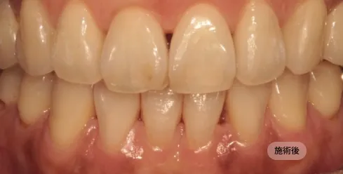 40代女性のインビザライン矯正治療後