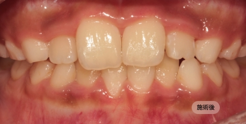 10代女性のインビザライン矯正治療後