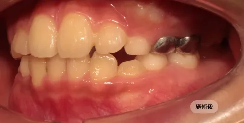 小児、不正咬合矯正治療後