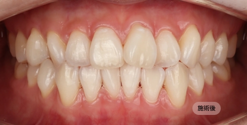 30代女性のホワイトニング後の写真