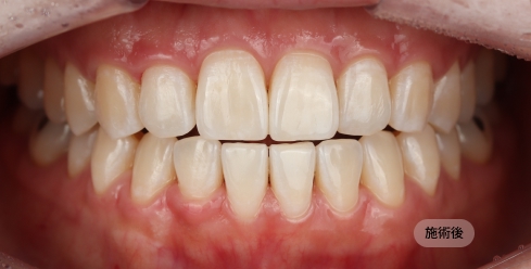 20代女性のホワイトニング後の写真