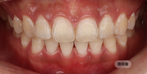 30代女性のホワイトニング後の写真