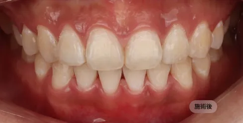 30代女性のホワイトニング後の写真