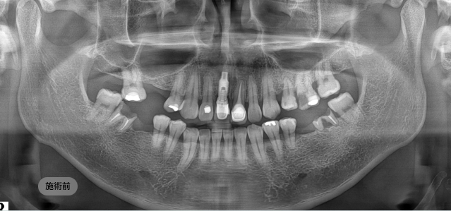 네비게이션 임플란트 시술 전 파노라마 엑스레이, 치아 결손 부위와 잇몸뼈 상태를 분석한 영상