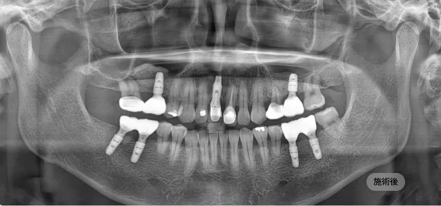 네비게이션 임플란트 시술 후 파노라마 엑스레이, 계획에 따라 임플란트가 정확히 식립된 상태