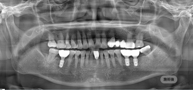 네비게이션 임플란트 시술 후 파노라마 엑스레이, 오차를 최소화해 임플란트가 자리한 결과