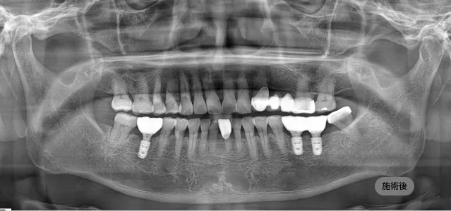 네비게이션 임플란트 시술 후 파노라마 엑스레이, 오차를 최소화해 임플란트가 자리한 결과