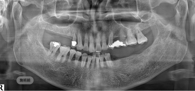 무절개 임플란트 시술 전 파노라마 엑스레이, 치아 결손과 잇몸뼈 상태를 정밀 진단한 치료 전 영상