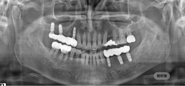 무절개 임플란트 시술 후 파노라마 엑스레이, 최소 침습으로 임플란트 식립이 완료된 치료 결과
