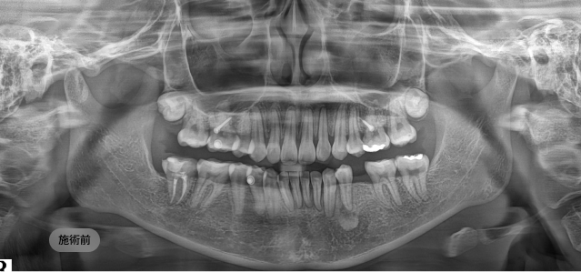 무절개 임플란트 시술 전 파노라마 엑스레이, 치아 상실 부위와 잔존 치근 상태를 확인한 전 상태