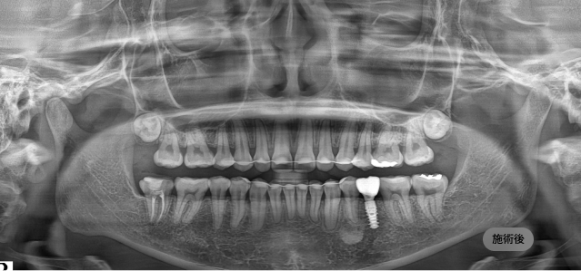 무절개 임플란트 시술 후 파노라마 엑스레이, 절개 없이 임플란트가 안정적으로 자리한 모습