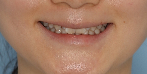 ウサギのような前歯