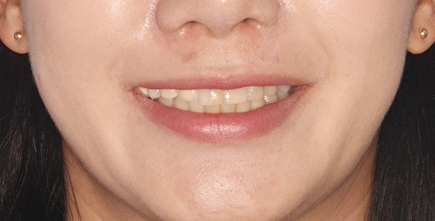 ラミネートの再治療