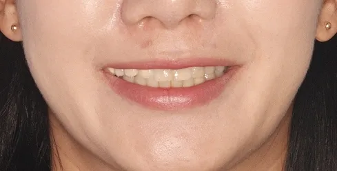 라미네이트 재시술