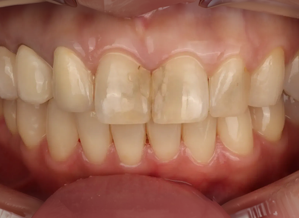 블랑쉬치과 저가 라미네이트 선택 시 주의점을 설명하는 정보 콘텐츠 이미지