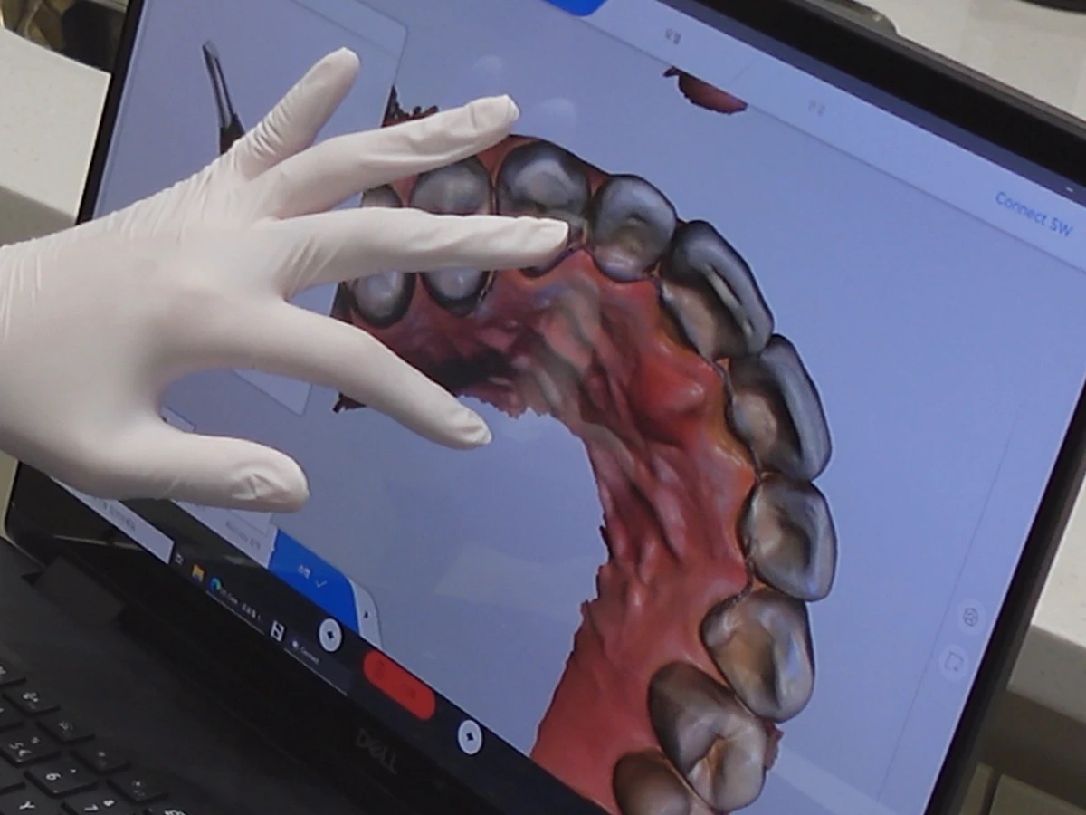 Intraoral Scan + Impression taking
