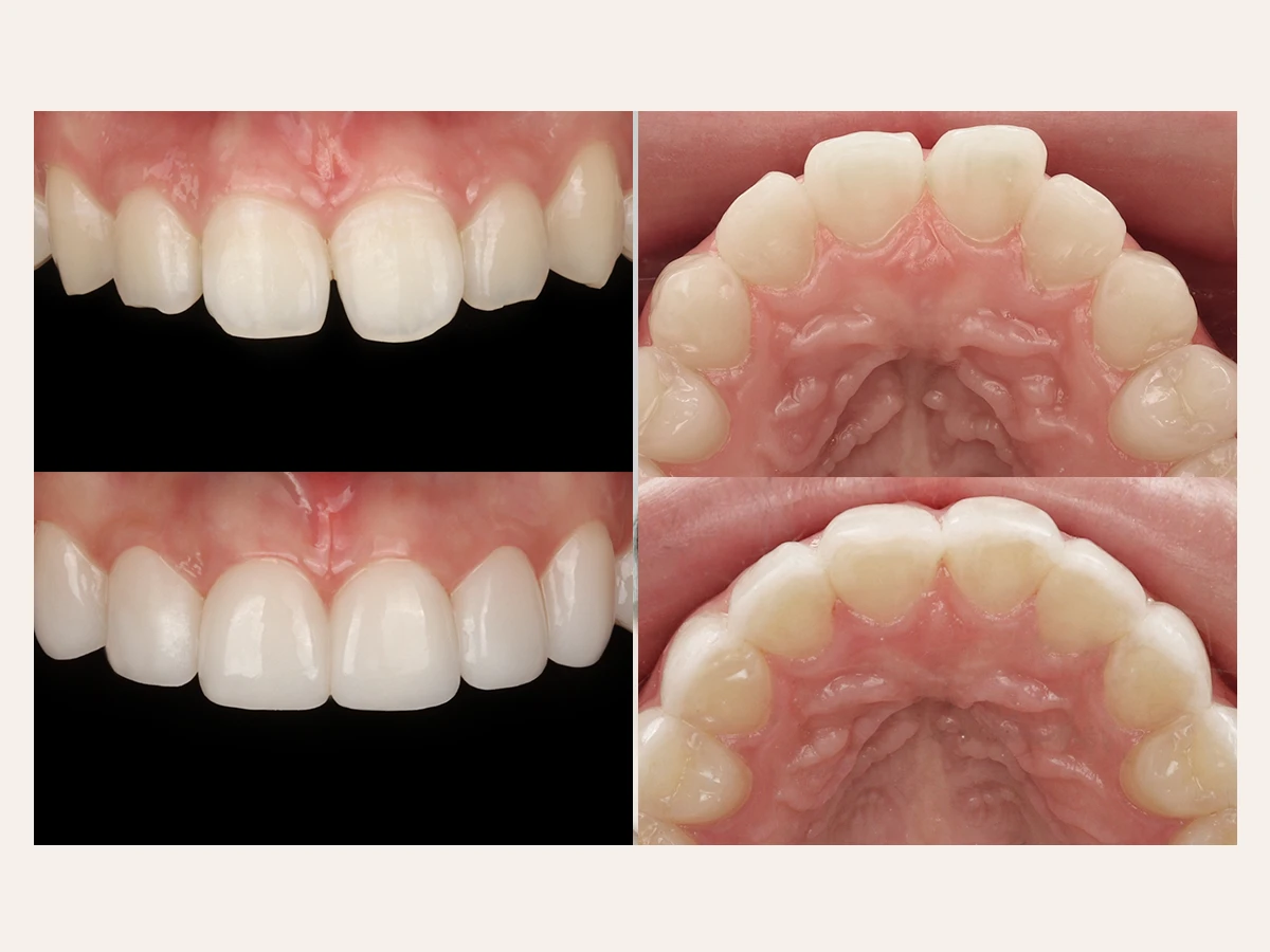 Precision Trial & Permanent Bonding