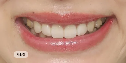 치료 전