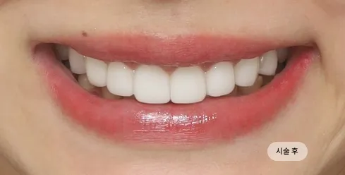 치료 후