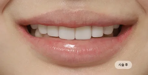 치료 후