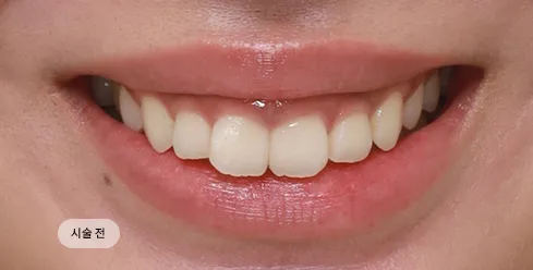 치료 전