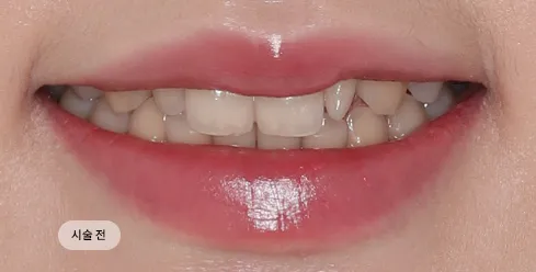 치료 전