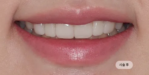 치료 후
