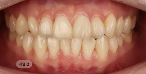 30대 여성 치아미백 시술 전, 전체적으로 어두운 치아 톤으로 웃을 때 인상이 흐려 보이는 상태
