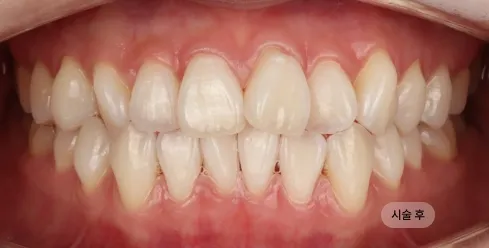 30대 여성 치아미백 시술 후, 치아 톤이 밝아지며 웃을 때 인상이 또렷하게 개선된 모습