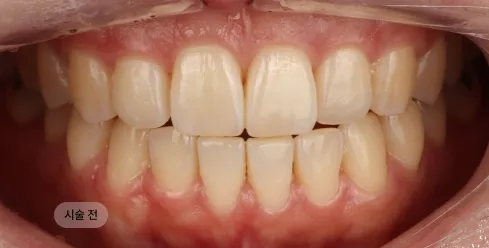 20대 여성 치아미백 시술 전, 누런 치아 색으로 인해 치아가 칙칙해 보이는 상태