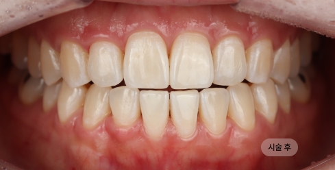20대 여성 치아미백 시술 후, 자연스러운 밝기의 치아 톤으로 깨끗하게 개선된 모습