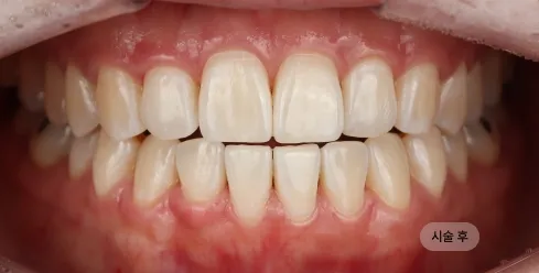 20대 여성 치아미백 시술 후, 자연스러운 밝기의 치아 톤으로 깨끗하게 개선된 모습