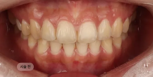 30대 여성 치아미백 시술 전, 커피 착색으로 치아 표면에 누런 색소가 남아 있는 상태