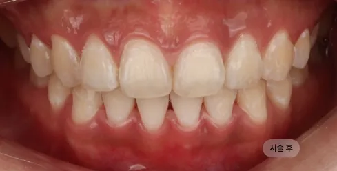 30대 여성 치아미백 시술 후, 착색이 제거되어 깔끔하고 균일한 치아 인상이 완성된 모습