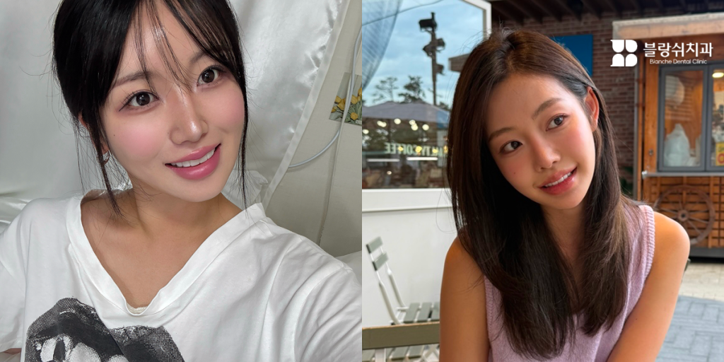 블랑쉬로 환한 미소가 빛나는 인플루언서 라미네이트 성공 사례