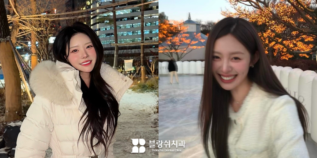 연예인 라미네이트, 자연스러워 보이는 이유를 보여주는 사진