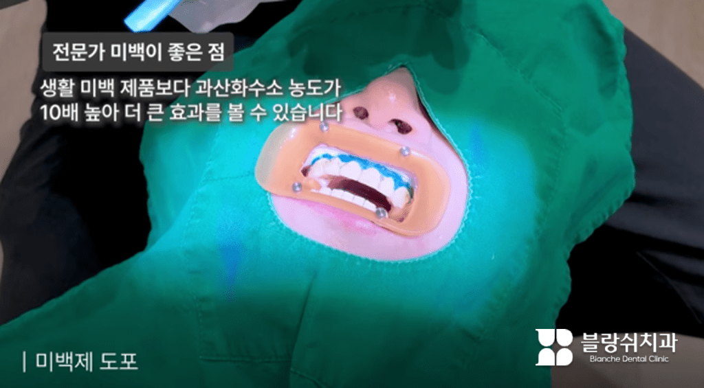 1.치과에서 고농도 미백제를 도포하는 전문가 치아미백 시술 장면