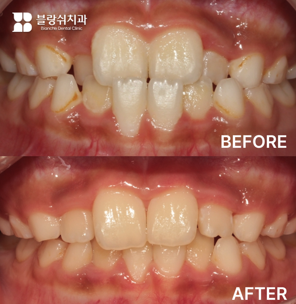 10대 성장기 교정, 반대교합을 개선한 인비절라인 사례
