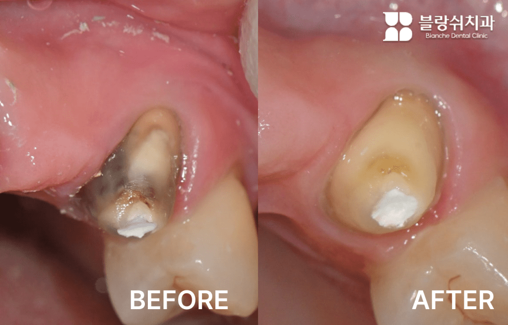 3.미백 치료 전 치아 전반에 변색이 관찰되는 구강 내 정면 사진