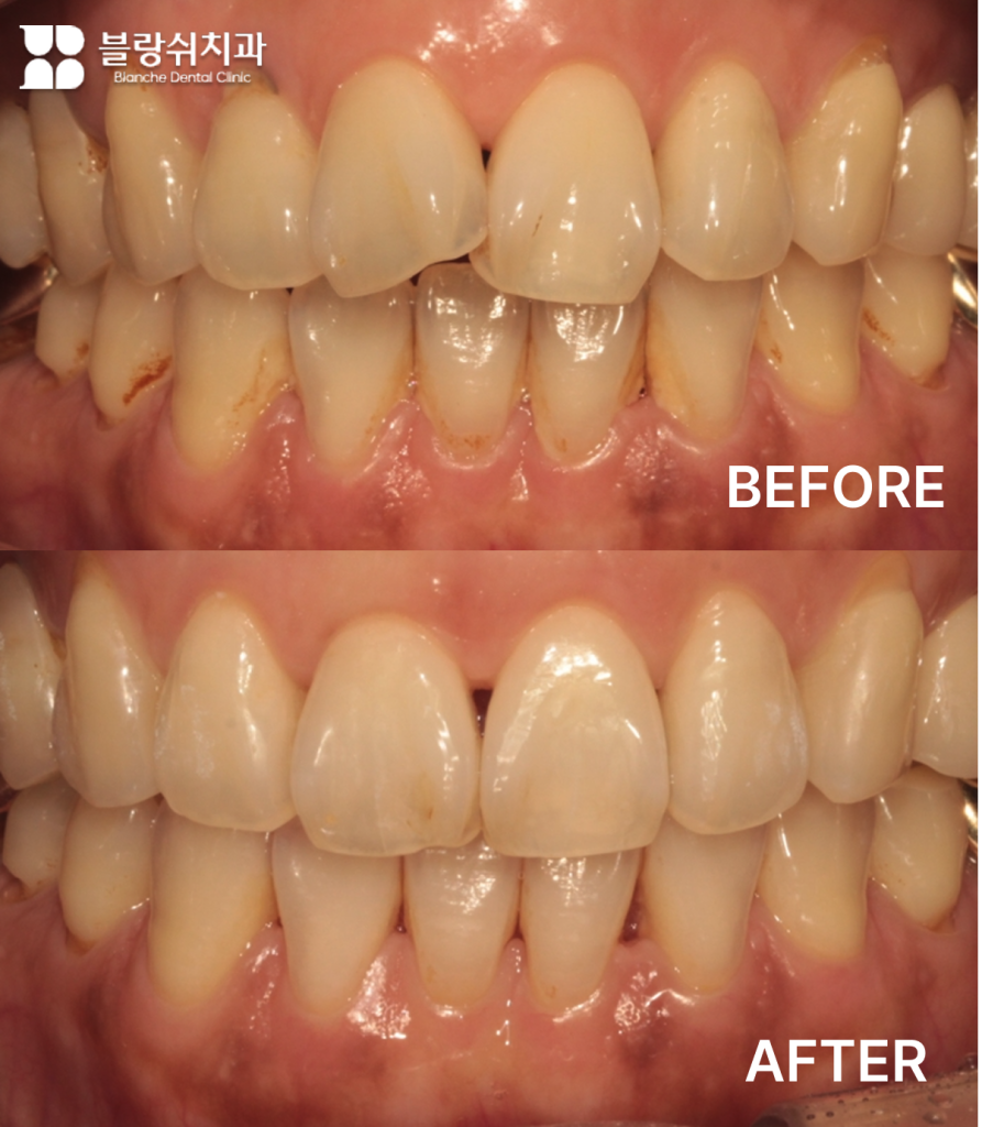 40대 앞니 불균형, 교합까지 고려한 인비절라인 교정 사례
